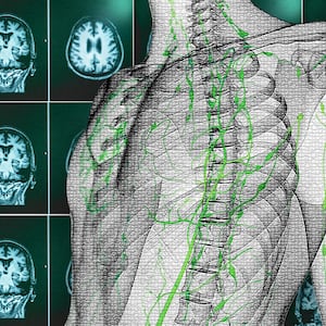 skeleton alzheimer's alzheimers disease no cure brain beta amyloid rudolph tanzi robert moir harvard