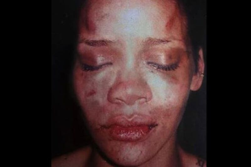 Rihanna_s_face_after_boyfriend_Chris_Brown_attacked_her_yug0lx