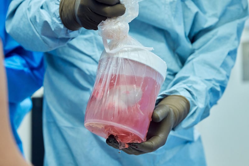 The pig kidney, which has the biomolecule alpha-gal removed to prevent rejection, is unpacked for transplant.