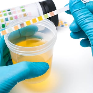 urinary tract infection uti image of blue hand glove holding urine sample with colored paper