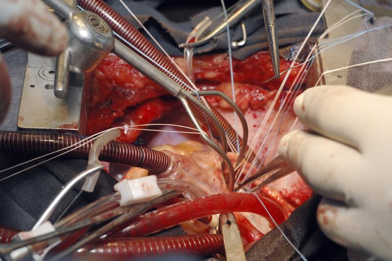 articles/2012/03/26/dick-cheney-surgery-7-essential-facts-about-heart-transplants/tbd-heart-transplants_afcnh5