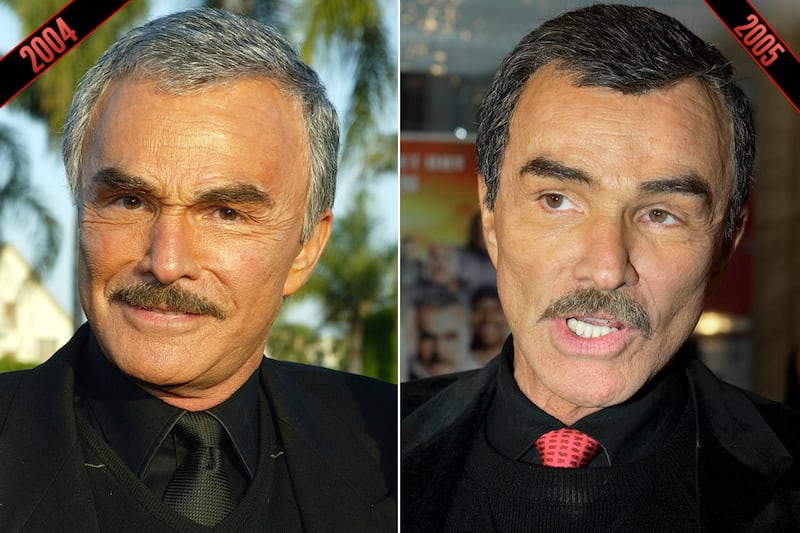 galleries/2011/10/05/simon-cowell-steve-martin-male-stars-rumored-plastic-surgery-photos/plastic-surgery-burt-reynolds-2_ub7xhs