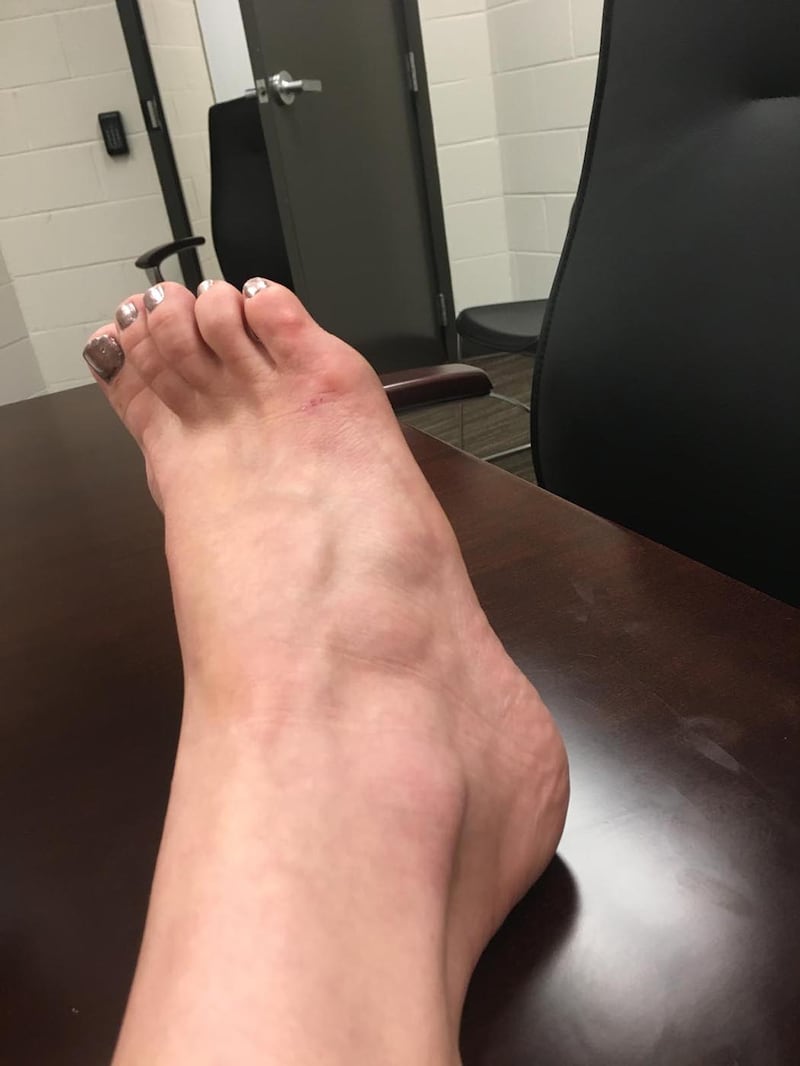 180626-woodruff-ice-broken-foot-embed_aduq1c