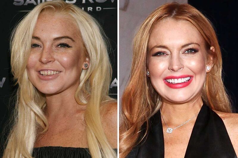 galleries/2012/06/08/jewel-lindsay-lohan-more-stars-who-fixed-their-teeth-photos/lindsay-lohan-celeb-teeth-corrections_ohpqtt