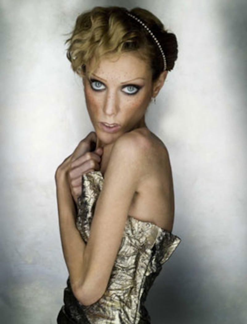 articles/2011/02/07/isabelle-caro-anorexic-model-dies-her-mother-commits-suicide-how-should-the-fashion-industry-respond/nadeau-anorexia_158306_idsvak