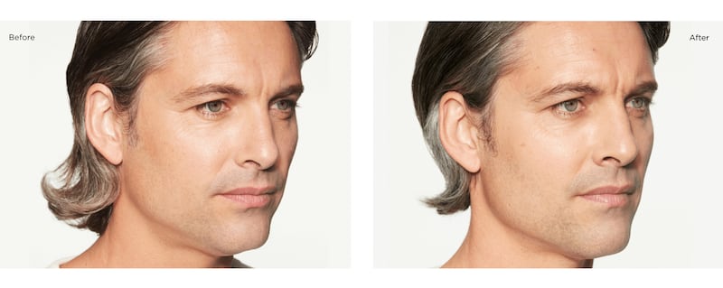 Sculptra Before and After Profile