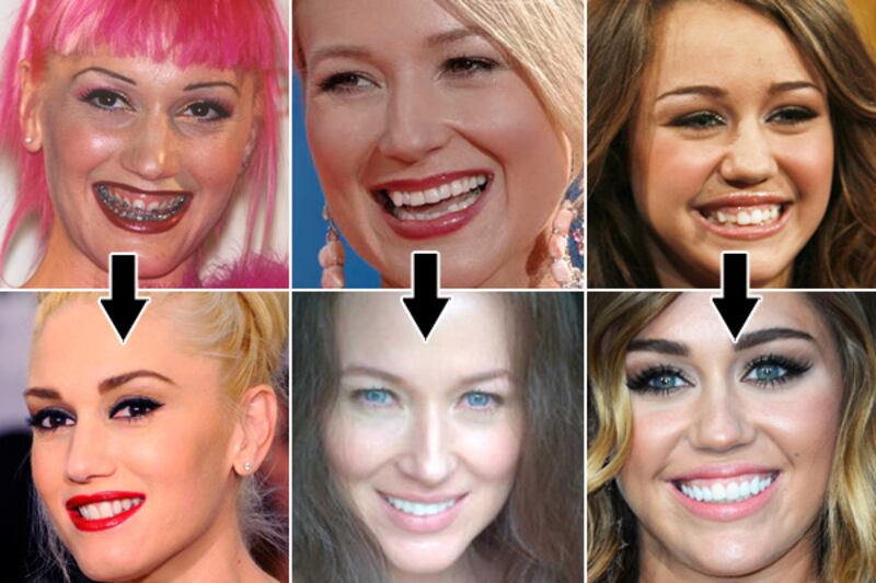 galleries/2012/06/08/jewel-lindsay-lohan-more-stars-who-fixed-their-teeth-photos/celebrity-teeth-fixers-tease_n6zaqp