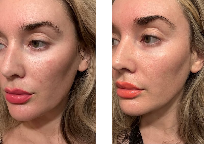 Plated Serum Before and After