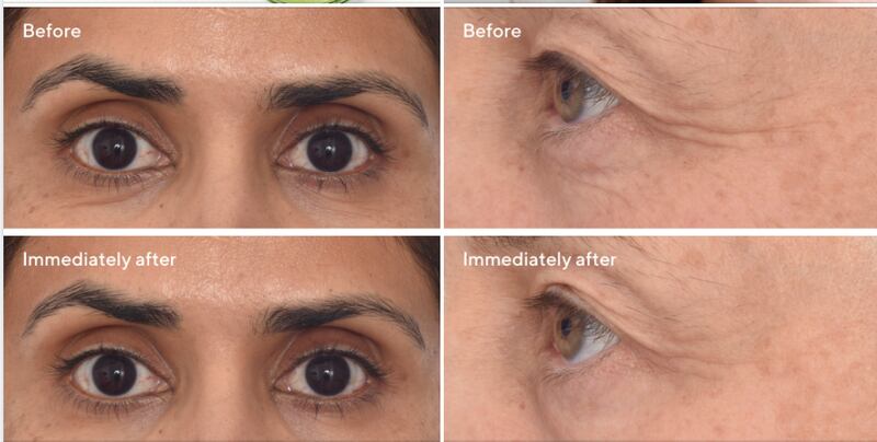 Murad eye mask dr zion before and after