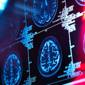 Stylized MRI scans showing patients' brains. 