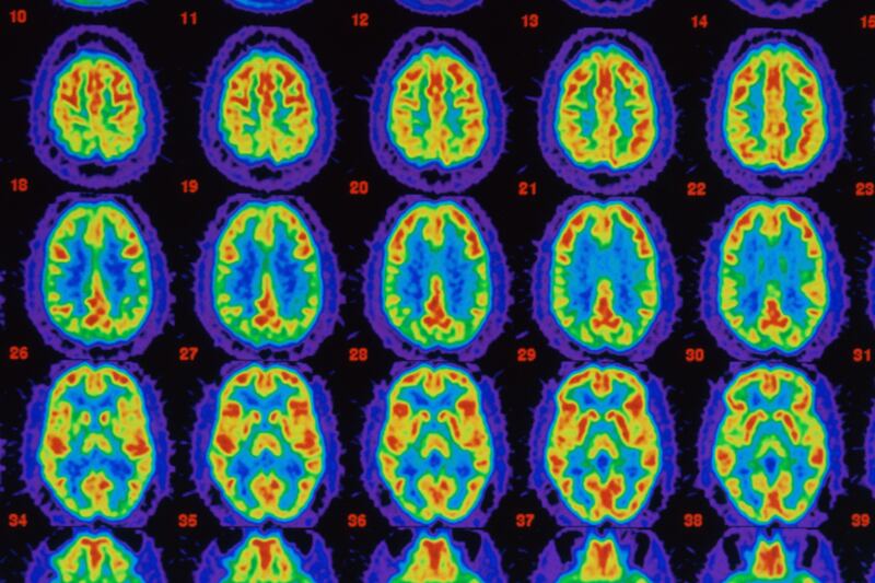 articles/2014/05/24/trial-drug-reverses-alzheimer-s-disease-in-mice/140523_Lopatto_alzheimers_mice_w0ooab