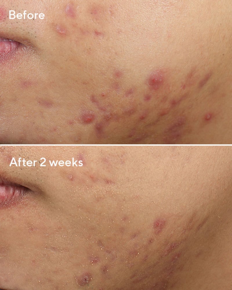 Murad deep relief acne treatment before and after